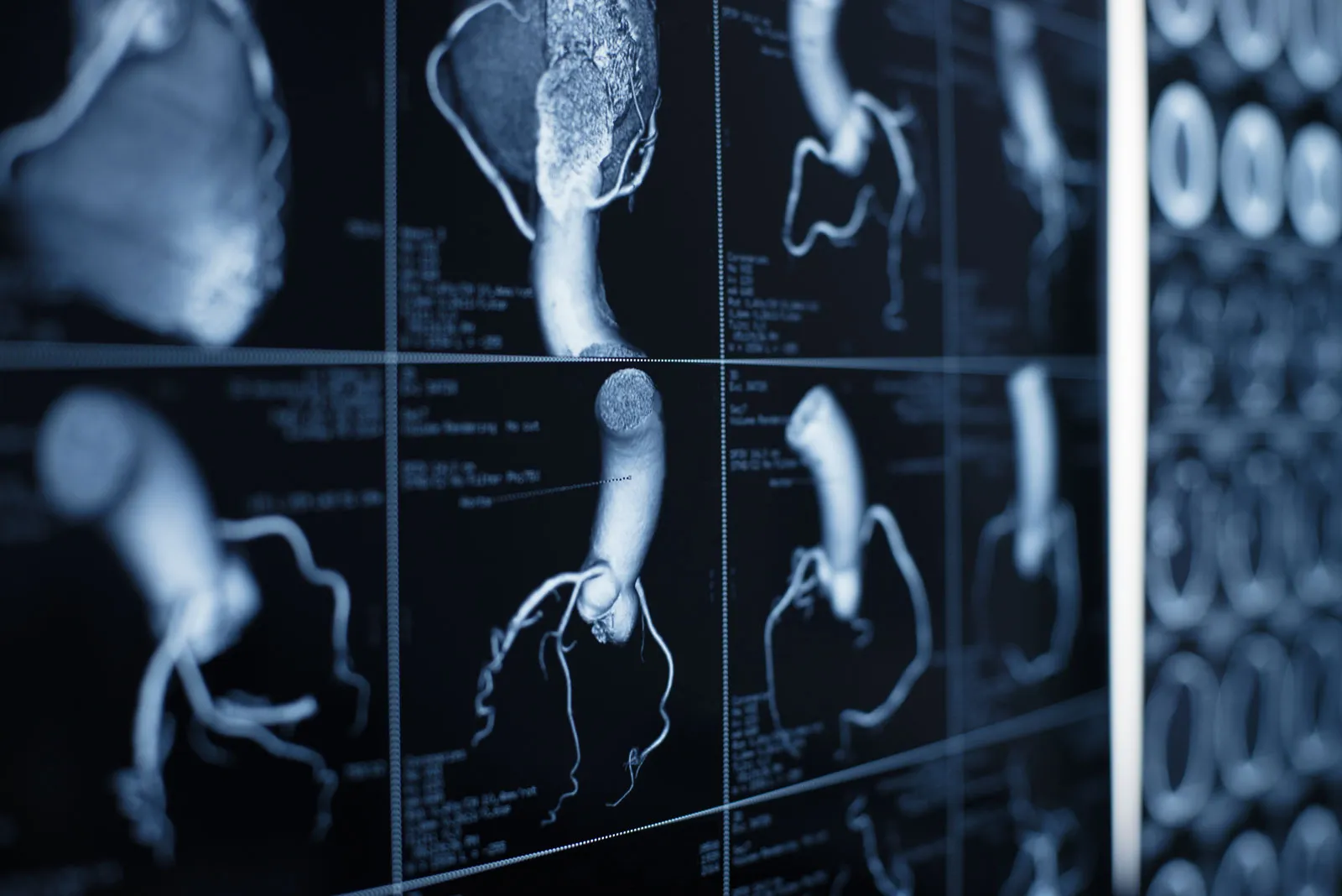 CT Cardiac Calcium Scoring Orchard Park, Buffalo, Springville & Hamburg ...